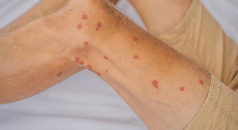 bed bug bites on human