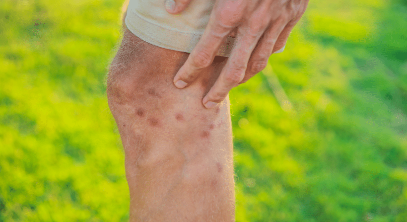misdiagnosis of bed bug bites