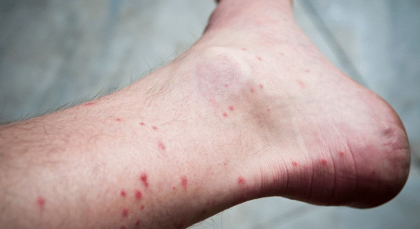 Mosquito Bites