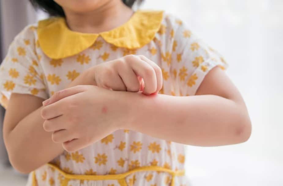 bed bug bites